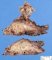 Colonic lymphangioma