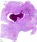 Mucous plug and bronchiectasis