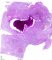 Mucous plug and bronchiectasis in cystic fibrosis