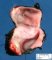 Duodenal duplication cyst