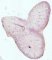 Feta adrenal clarification in hydrops fetalis (25 weeks)