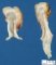 Hydronephrosis with chronic interstitial nephritis