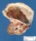 Fetal hydronephrosis with polar cystic dilatation