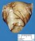 Intestinal duplication cyst