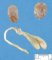 Vesical agenesis and bilateral renal agenesis in urinary agenesis (Case (...)