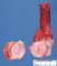 Chondroid teratoma component of a mixed germ cell tumor (yolk sac (...)