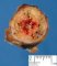 Thyroid papillary carcinoma
