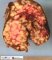 Torsion of an ovary with juvenile granulosa tumor