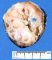 Testicular mixed germ cell tumor