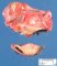 Ovarian mature teratoma