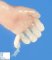 Post-axial polydactyly