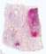Pulmonary hemorrhages