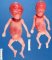 Twin-twin transfusion syndrome