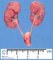 ARPKD kidney at 21 weeks