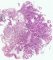 Gastric Peutz-Jeghers polyp