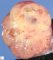 Testicular endodermal sinus tumor (Yolk sac tumor)