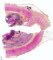 Colonic stenosis in Crohn disease