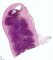 Appendiceal lymphoid hyperplasia