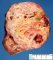 Cystic Wilms tumor