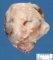 Fetal hydronephrosis with polar cystic dilatation