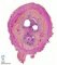 Jejunal atresia in multiple intestinal atresia syndrome