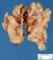 Plexiform neurofibroma in neurofibromatosis type 1 (NF1)