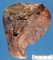 Pulmonary zygomycosis by Rhizomucor infection