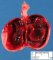 spermatic cord torsion