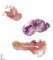 Megacystis, bilateral obstructive multicystic renal dysplasia (BOMRD) with (...)