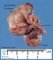 Pericardial teratoma.