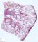 Renal ARPKD (34 weeks)