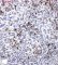Epithelioid fibrous histiocytoma