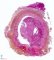 Thrombosis of hepatic artery in hepatic allograft