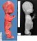 Thanatophoric dysplasia (20 weeks)