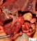 Duodenal dilatation in multiple intestinal atresia syndrome