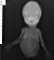 Caudal dysplasia and lower limb agenesis in maternal diabetes (Case (...)