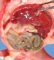 Caudal regression syndrome with lumbosacral agenesis and situs (...)