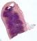 Appendiceal lymphoid hyperplasia