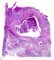 Bronchiectasis in cystic fibrosis and peribronchial inflammation in cystic (...)