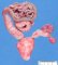 hydronephrosis with rectovesical fistula