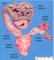 Anorectal agenesis with horseshoe kidney