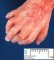 Post-axial polydactyly in Meckel syndrome