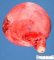 Parietal uterine leiomyoma