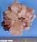 Botryoid embryonal rhabdomyosarcoma of the nasopharynx
