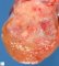 Testicular embryonal carcinoma