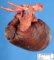 Left ventricle hypoplasia and severe aortic hypoplasia