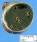 Meconial plug in meconial ileus