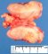 Nodular sclerosing Hodgkin disease