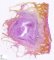 Pilonidal sinus cyst