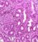 Active focal gastritis in Crohn gastritis